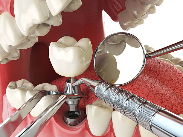 Best Emergency Dental Extractions in Beckett Ridge, OH